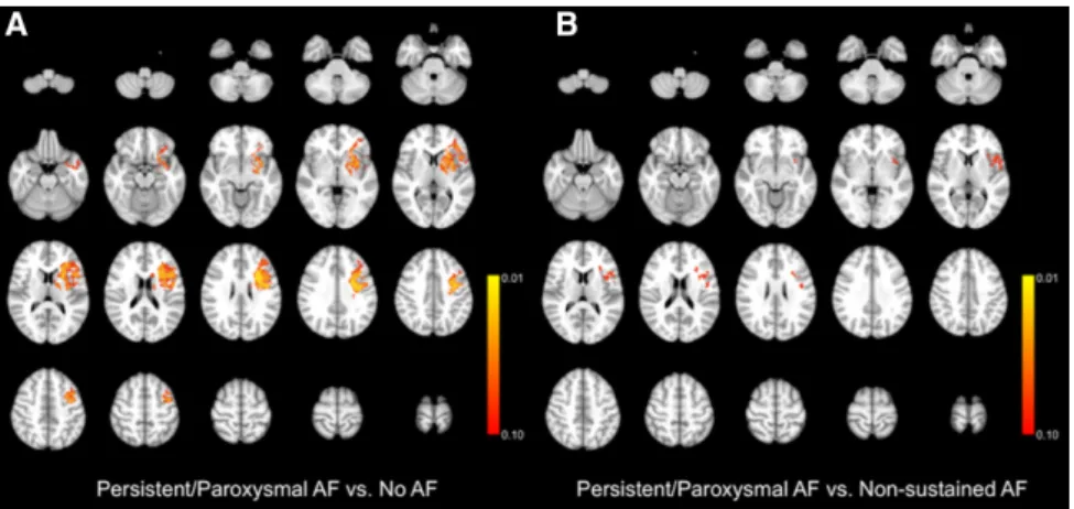 Figure 3.   Voxel-wise comparison of  lesion distribution probability maps  among patients with  persistent/paroxys-mal atrial fibrillation (AF) vs cryptogenic  stroke without nonsustained AF (A), and  patients with persistent/paroxysmal AF vs  cryptogenic