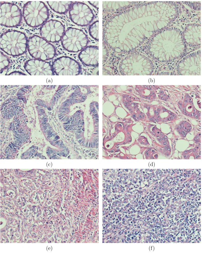 Figure 2.2: Examples of colon tissue images: (a)-(b) normal tissues, (c)-(d) low- low-grade cancerous tissues, and (e)-(f) high-low-grade cancerous tissues.