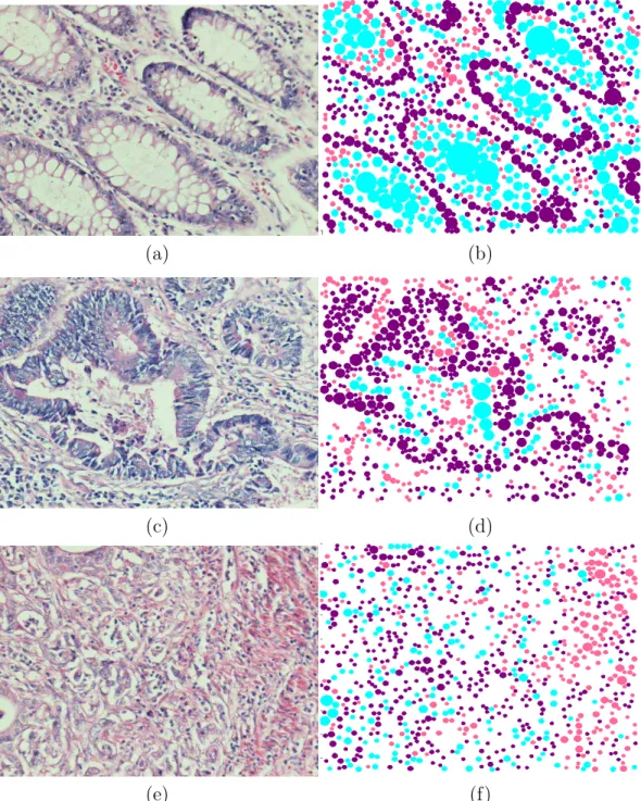 Figure 3.1: Examples of tissue images and their located objects. In these images, (a) a normal tissue image, (c) a low-grade cancerous tissue image, (e) a  high-grade cancerous tissue image and (b)(d)(f) the objects located on these tissue images