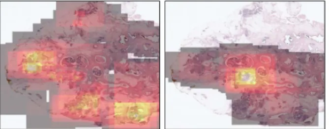 Fig. 1. Illustration of the viewing behavior of two pathologists as heat maps indicating the amount of time a particular pathologist spent on a particular image area