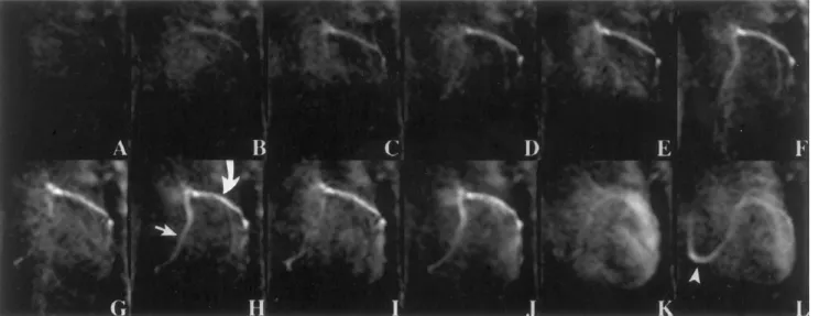 Figure 1 shows representative results from the ﬁrst demonstration of real-time coronary MRA with IA  in-fused contrast-agent enhancement (16) in dogs