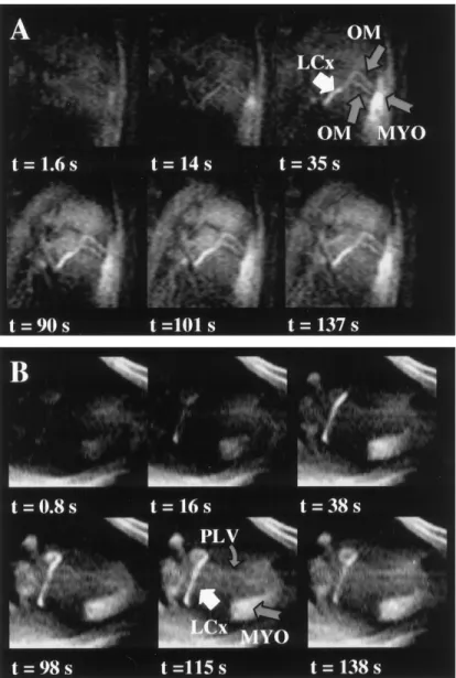 Figure 4. Example of an angiographic multislice study with the SR-prepared GRE that collected 180 frames composed of ﬁve slices prescribed to image multiple coronary vessels over a period of 2.3  min-utes, during intraarterial infusion of Gd-based  con-tra