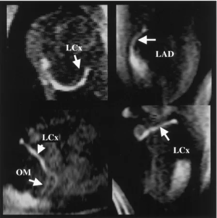 Figure 10. A: MR localization (scout) image shows the LCx (arrows) of a dog before injection of contrast agent