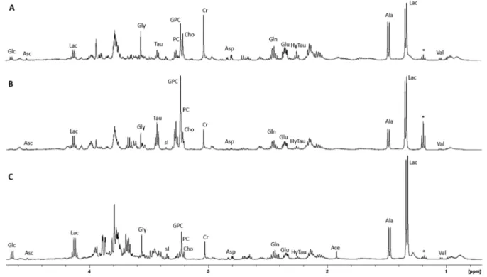 Figure 4. Comparative spectra of grade I meningiomas [(A) Ki-67 rate: 4%; positive PR expression] and grade III meningiomas [(B) Ki-67 rate: