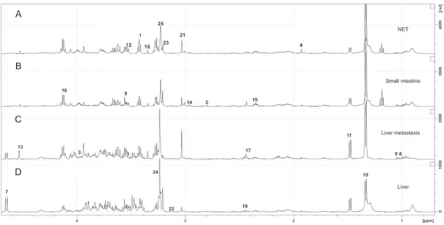 Figure 1. Representative 1D 1H Carr-Purcell-Meiboom-Gill (CPMG) high-resolution 1H magic angle  spinning (HRMAS) spectra between 4.7 and 0.70 ppm of G2 neuroendocrine tumor (NET) (A), normal  small-intestine (B), hepatic NET metastasis (C), and normal live