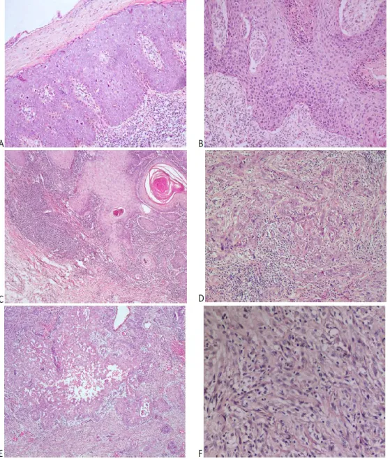 Fig 1.4.  Histopathologic appearances of the cutaneous squamous cell carcinoma (cSCC)
