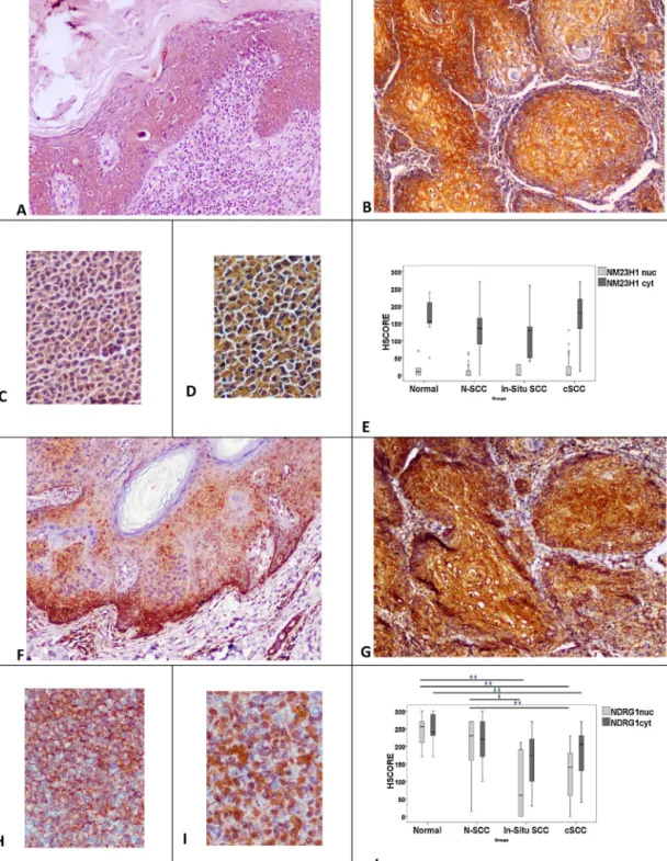 Fig. 1. NM23-H1 expression in in situ (A) and invasive carcinoma (B). Besides strong cytoplasmic expression, weak nuclear expression of NM23-H1 is occasionally detected in invasive carcinoma (B)