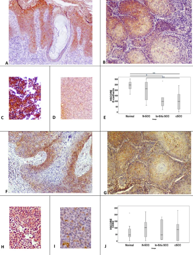 Fig. 2. Membranous E-cadherin expression in in situ (A) and invasive (B) carcinoma. The downregulation is easily detected in SCC