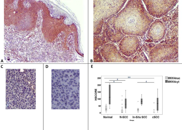 Fig. 4. MKK4 expression in in situ and invasive SCC (A, B). MKK4 cyt expression is clearly seen in in situ (A), but shows weaker staining in SCCs (B)