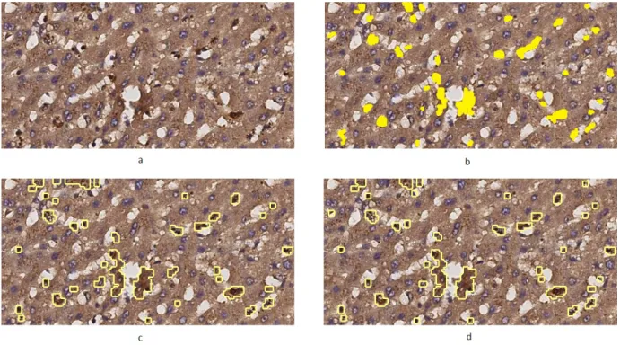 Figure 3. A CD13 stained image (a), its ground truth image marked by pathologist (b), first result of the MoL algorithm (c), achieved result after user feedbacks (d).