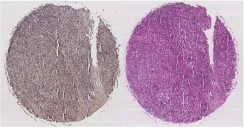 Figure 4. CD13 (left) and H&amp;E (right) stained serial section tissue images of the same patient.