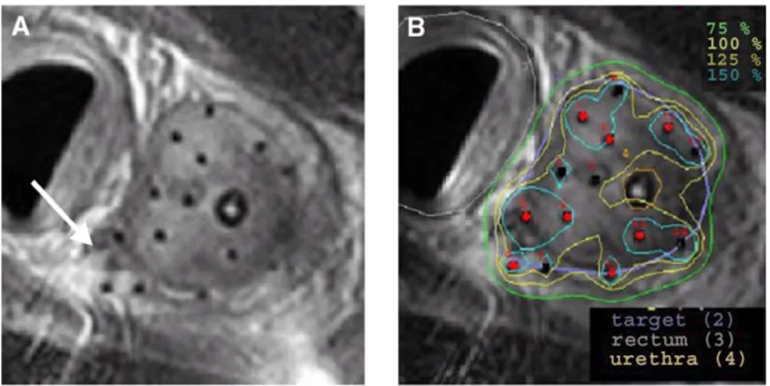Fig. 10. High dose rate brachytherapy in a 1.5-T scanner. (A) Fourteen brachytherapy catheters (signal voids) were placed throughout the prostate gland and at sites of visualized extracapsular extension (arrow)