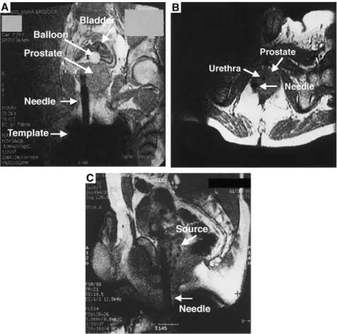 Fig. 3. Images obtained during MR-guided diagnosis and treatment of prostate cancer in a 62-year-old man