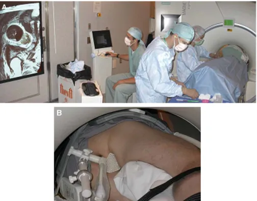 Fig. 4. Setup for transperineal biopsy in a conventional 1.5-T MR imaging scanner. (A) Prostate images are displayed within the scanner room using stereotactic targeting software