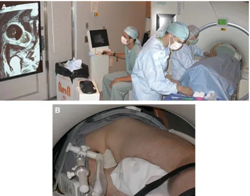 Fig. 4. Setup for transperineal biopsy in a conventional 1.5-T MR imaging scanner. (A) Prostate images are displayed within the scanner room using stereotactic targeting software