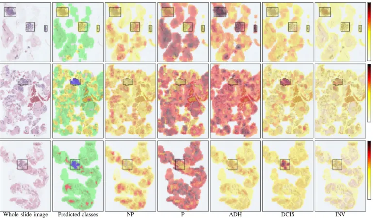 Fig. 5. Whole slide ROI-level classification examples. From left to right: original image; each 1200 × 1200 window is colored according to the class with the highest score (see Figure 2 for the colors of the classes); scores for individual classes using th