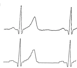 Figure  1.5:  AZTEC  representation of an  ECG  waveform.