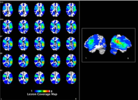 Fig. 1. Coverage map indicating the lesion locations for all participants with brain damage