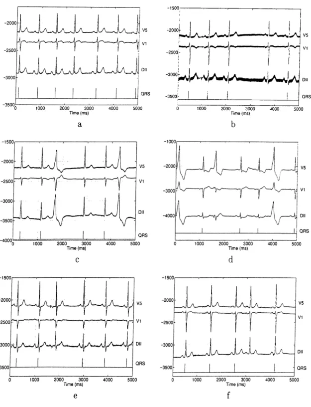 Figure 2.4:  Typical  correct  and  incorrect identification cases  of normal and ectopic beats