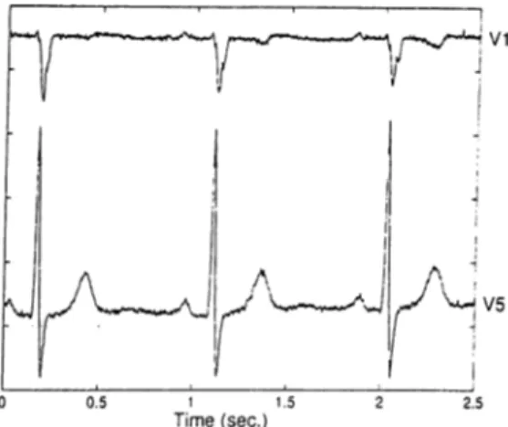Figure  2.6:  The  normal  beat  in  the  third  position  was  missed  on  VI  but  detected  on  V5  during single  channel  HRV  analysis