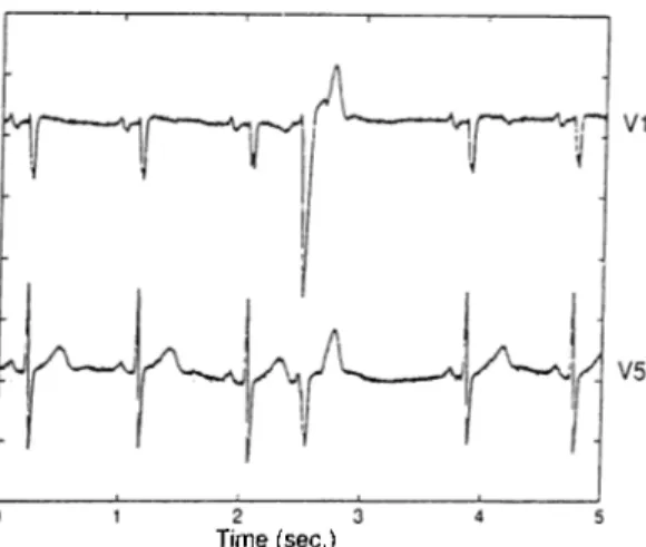 Figure  2.8;  The  VE  in  the  fourth  position  was  missed  on  V5  but  detected  on  VT  during  single  channel  HRV  analysis