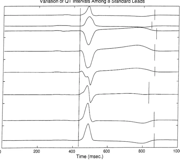 Figure  3.2;  QT  dispersion  (QTd)  is  defined  in  the  variation  of the  QT  intervals  over  12  standard  ECG  leads