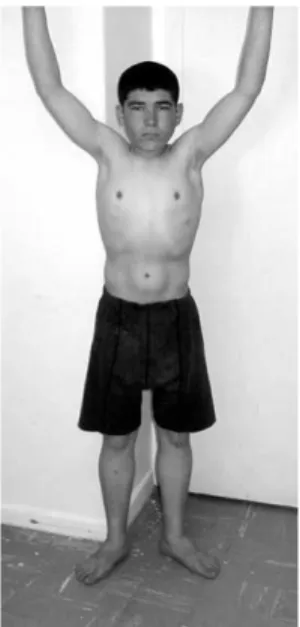 Fig. 1. Case 1: can easily raise arms above head, mild pseudohypertrophy, IQ 55.