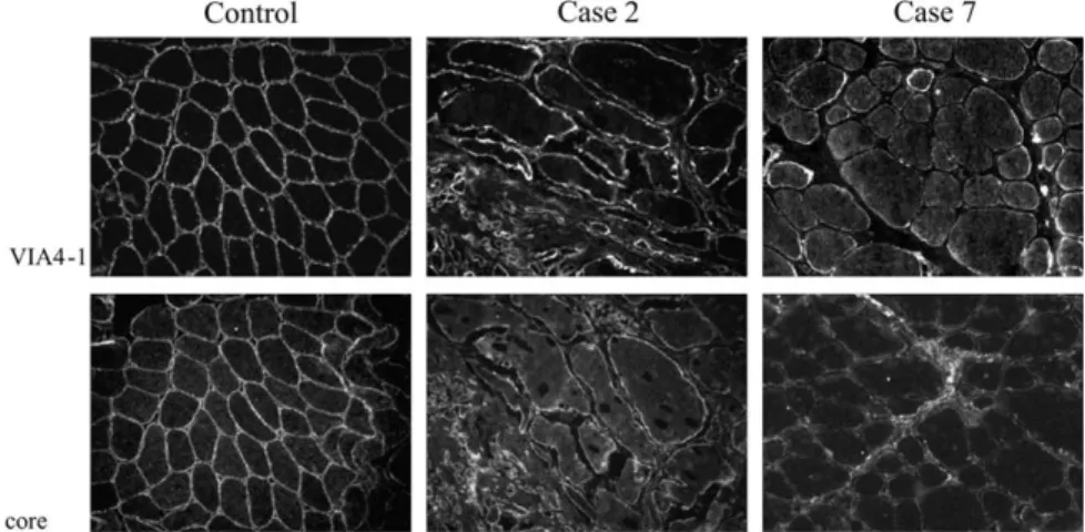 Fig. 4. Immunocytochemical analysis of a-dystroglycan by using VIA4-1 and core antibodies in cases 2 and 7.