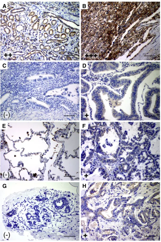 Fig. 2. Increased expression of SIP1 in kidney, lung, breast and uterus tumors. Representative photographs show increased SIP1 expression in tumors relative to their normal tissues as detected by immunohistochemistry performed by both antibodies
