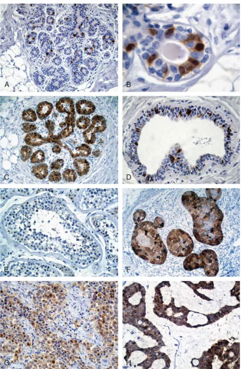 FIGURE 3. IHC staining with mAb NY-BR- NY-BR-1#2 in normal (A-D) and neoplastic (F, G) breast tissue, testis (E), and mucinous sweat gland (eccrine) carcinoma (H) (ABC method, DAB chromogen)