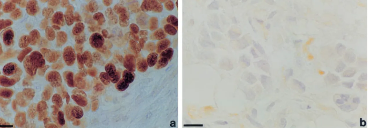 Figure 1 Immunocytochemical analysis of p53 expression in BRCA1-associated breast cancer