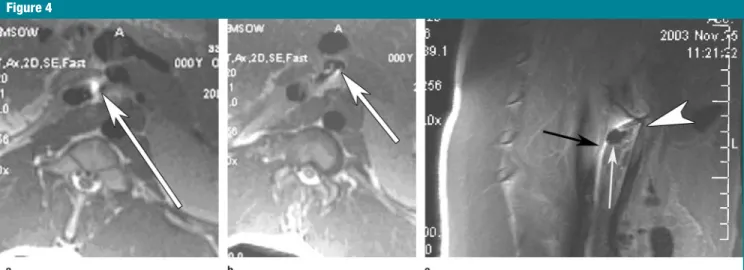 Figure 4: (a) Transverse fast spin-echo MR image (1900/4.5, 90° flip angle) shows that the intravascular needle (area of high signal intensity indicated by arrow) has exited the IVC