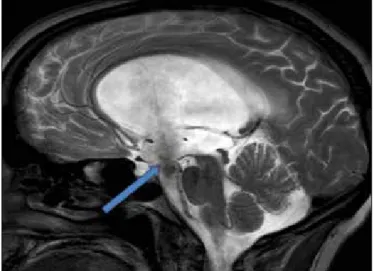 Figure 2:  On  sagittal  T2  weighted  3D  DRIVE  MRI  sequence  patency of the third ventriculostomy is seen (arrow)