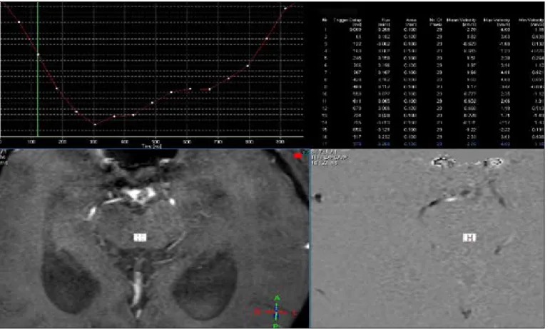 Figure 6:  Normalization of aqueductal CSF flow pattern following third ventriculostomy is seen