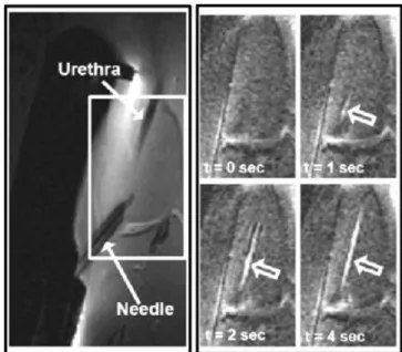 Fig. 4. Canine Single-Injection Trials: Injected contrast solution tracking along the intraprostatic urethra