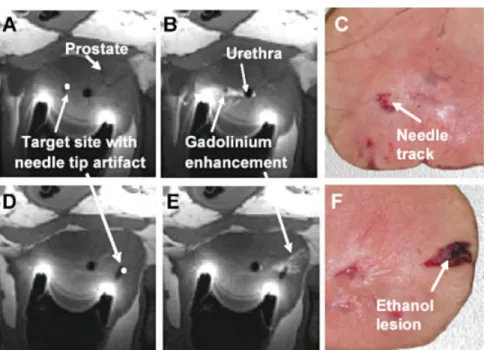Figure 10 shows that the three formalin-fixed pros- pros-tate injections showed very poor tissue coverage  com-pared to the fresh prostates