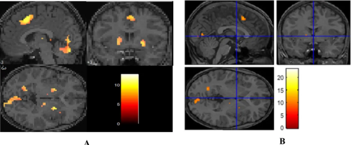 FIGURE 8. Multisubject fMRI images for the two approaches are applied with pseudo t-statistic nonparametric-random permutation test and RFT