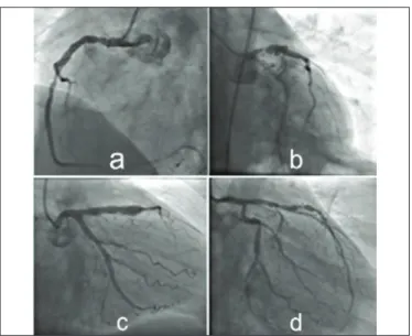 Figure  1: (a) proximal  segment  ectasia  of  RCA;  (b) In-stent  proximal segment  ectasia  of  LAD  with  severe  coronary  stenosis;  (c) Native  LAD diffuse aneurysm; (d) multiple ectasias on Cx.