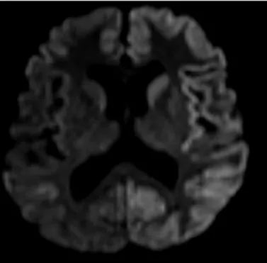 Figure 2:  “cortical ribboning sign” on diffusion MRI of the patient. Figure 3:  Bilateral periodic sharp waves activity on EEG.