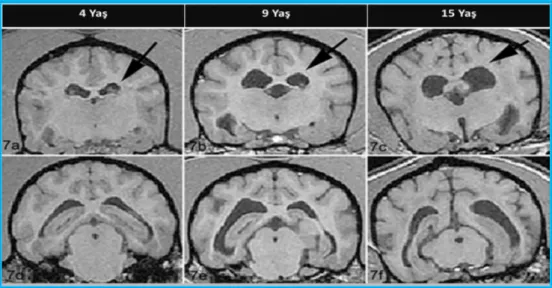 Şekil 2.1. Köpeklerde (4, 9 ve 15 Yaş) Kortikal Atrofi ve Ventriküler Dilatasyon   Manyetik Rezonans Görüntüleri.( Su ve ark., 1998)