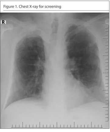 Figure 2. Bilateral, multiple pulmonary nodules on thoracic  computed tomography