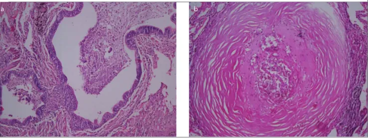 Figure 3. a, b. Histopathologic examination (Hematoxylin and eosin staining, 100×). (a) Lung biopsy specimen showing a small  bronchus filled with mucinous material and inflammatory cells