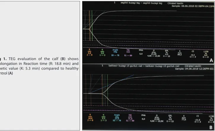 Fig 1. TEG evaluation of the calf (B) shows  prolongation in Reaction time (R: 18.8 min) and  Kinetic value (K: 5.3 min) compared to healthy  control (A) 