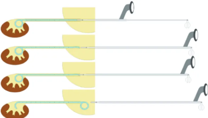Figure 1. Retrograde placement of double-J stent with grasping  forceps via ureteroscope working channel