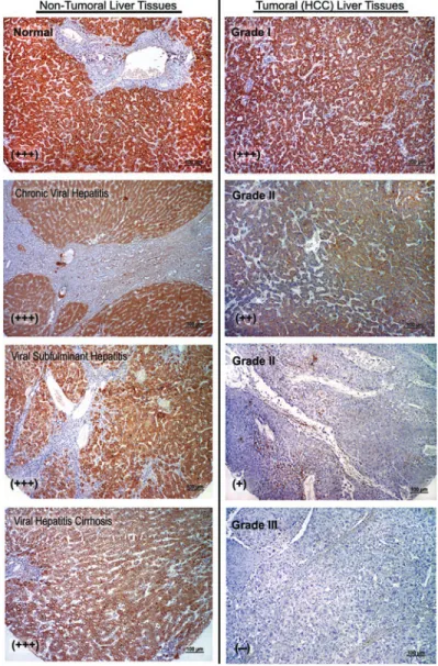 Table 1. Immunostaining of Human Liver Tissues with PTPRD Antibody PTPRD expression (staining intensity)