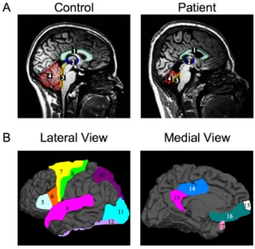 Figure 3.3: Morphological analysis of brain from aected and unaected individ- individ-uals