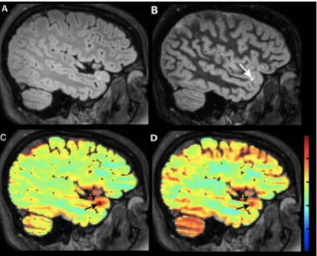 Figure 13. Patient with relapsing –remitting multiple sclerosis with cortical lesion (arrows)