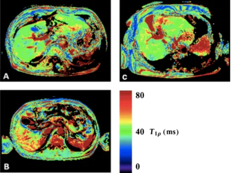 Figure 17. Colored T 1ρ maps. (A) A 68-year-old man, mean T 1ρ = 38.5 ms, indocyanine green (ICG-R15) = 9.3%