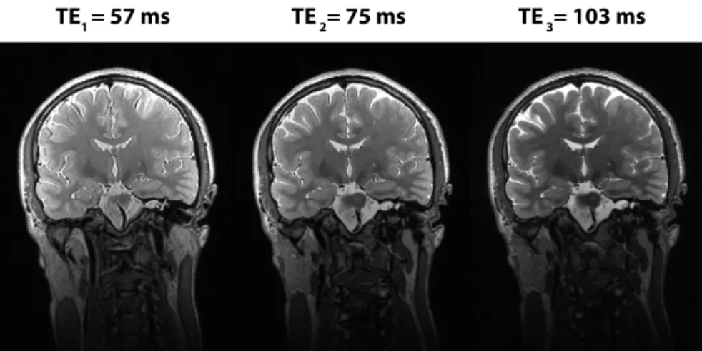 Figure 2.6: Multiple T 2 -weighted coronal images with different echo times are for a healthy subject.