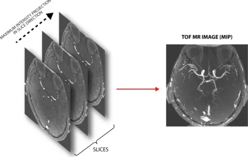 Figure 2.7: Multiple slices for TOF images and the corresponding Maximum intensity projection (MIP).